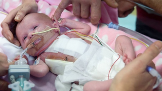 El extraordinario caso médico de la niña que ha nacido en Reino Unido con el corazón fuera del pecho<em></em>